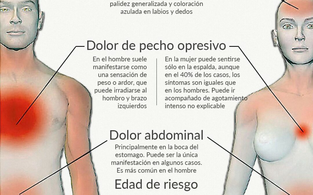 Infartos de Miocardio en hombres y mujeres